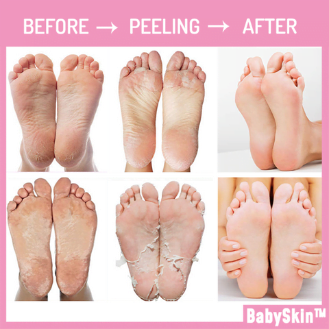 Baby Feet Exfoliation Foot Peel 6
